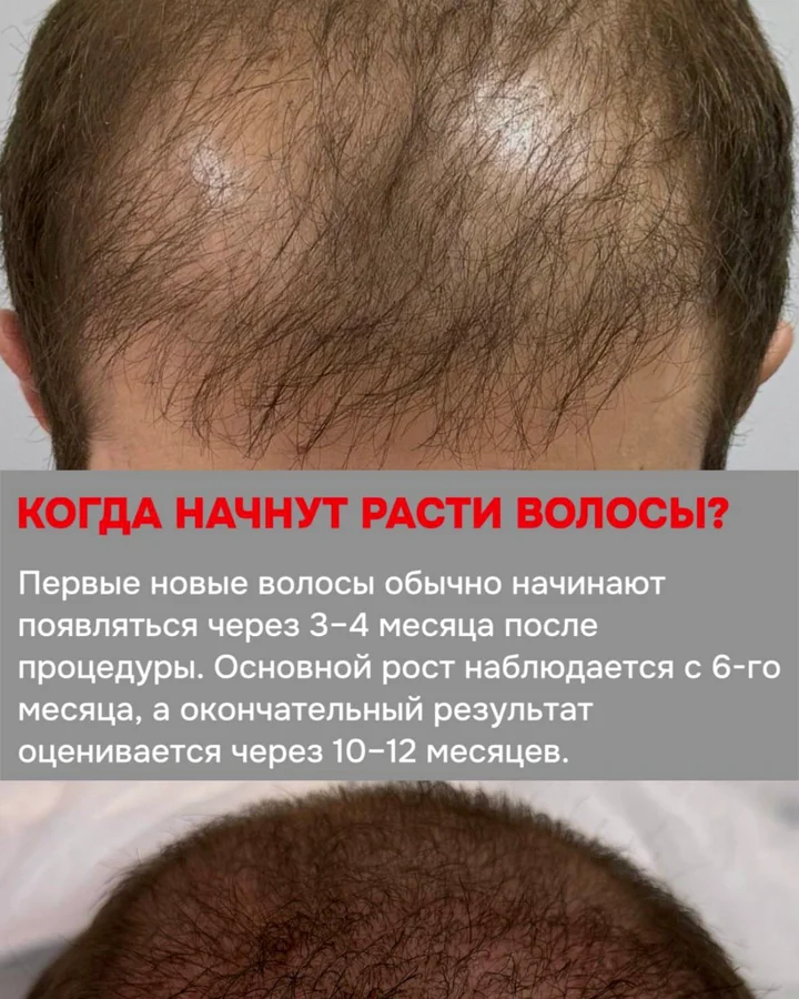 Реальный результат пациента USISHA
