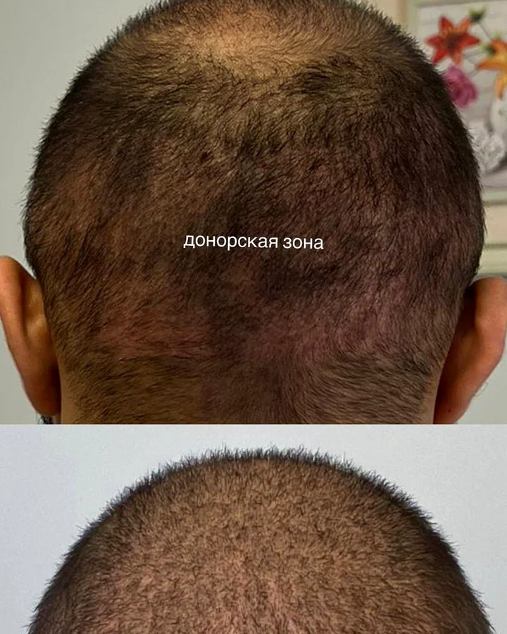 Реальный результат пациента USISHA