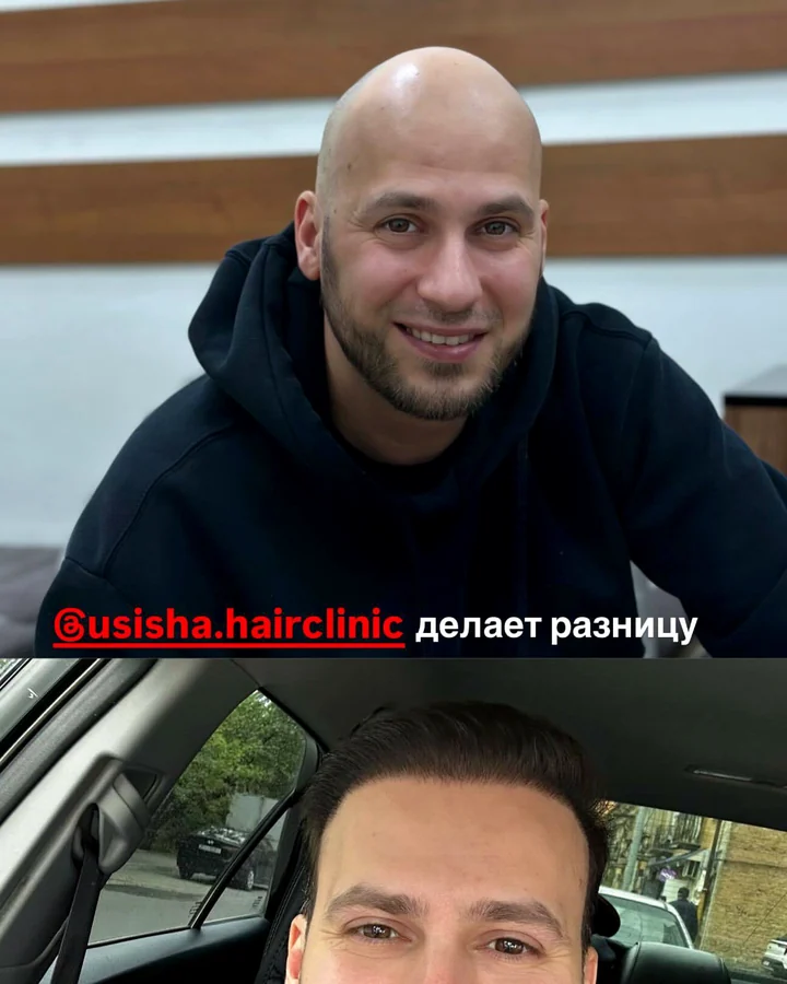 Реальный результат пациента USISHA
