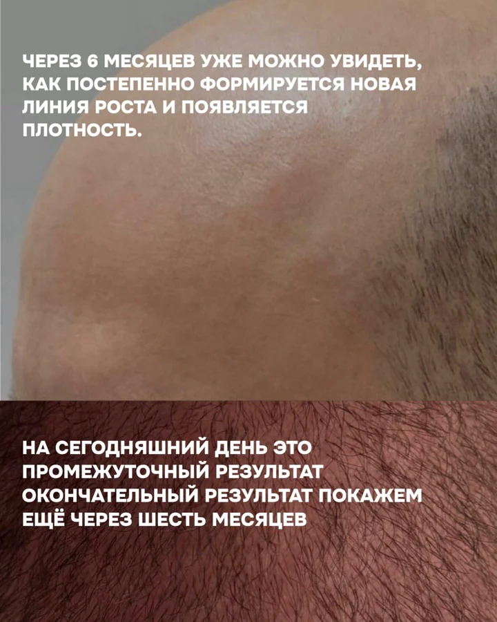 Реальный результат пациента USISHA